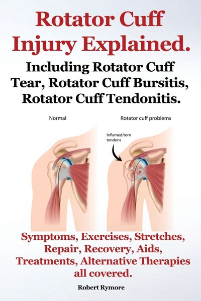 Характеристики Rotator Cuff Injury Explained Including Rotator Cuff Tear Rotator Cuff Bursitis