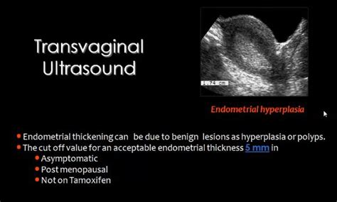 Usg Et Of 5mm Endometrial Hyperplasia Radiology Pelvis