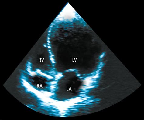 Figure Echocardiography Apical Chamber View Of A Patient