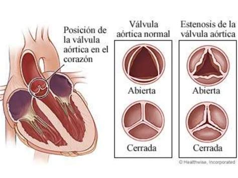 Valvulopatia Mitral Aortica Ppt