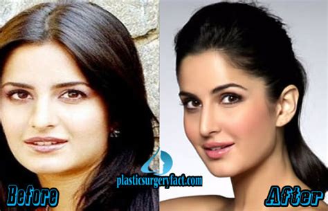 Katrina Kaif Plastic Surgery Before And After Photos