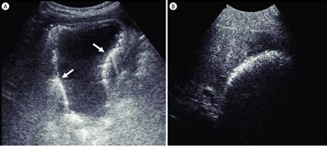 Emphysematous cholecystitis. (A) Ultrasound of the gallbladder ...