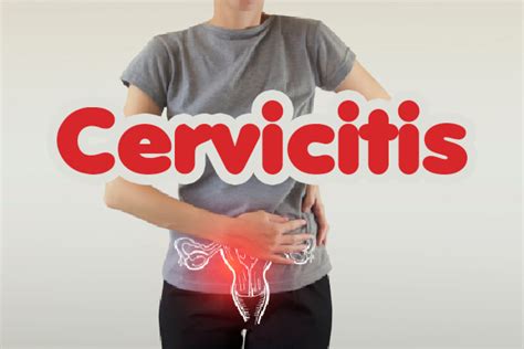 ¿qué Es La Cervicitis Clinica La Caridad