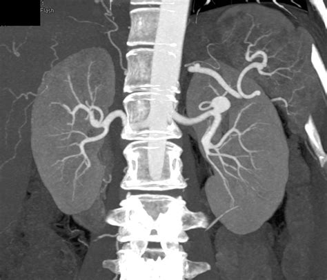 Left Renal Artery Aneurysm Kidney Case Studies Ctisus Ct Scanning