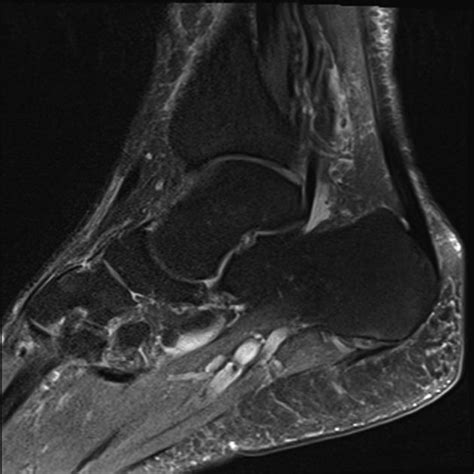 Mri Of A Torn Tendon Foot