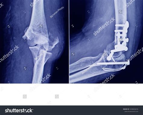 Medial Epicondyle Humerus