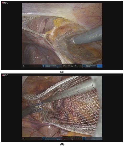 Medicina Free Full Text Initial Experience Of Robot Assisted Transabdominal Preperitoneal