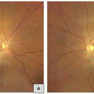 Normal Color Fundus Photograph Of Right Eye A And Left Eye B