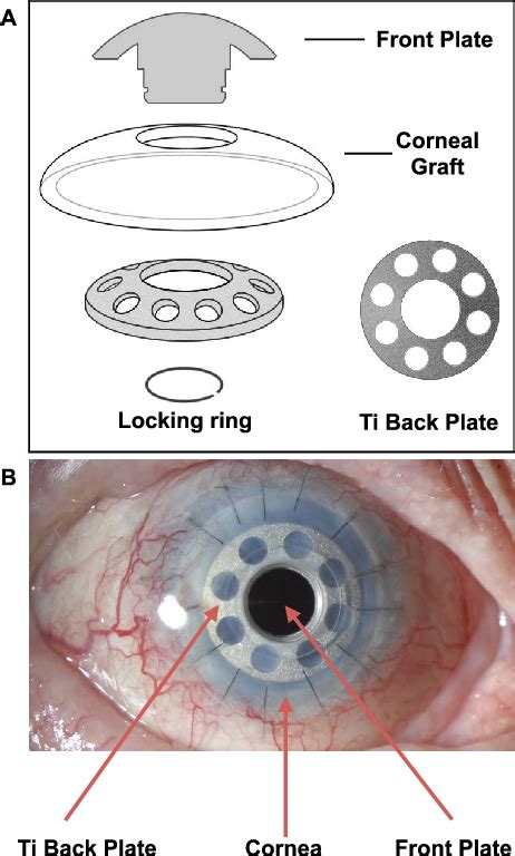 Keratoprosthesis