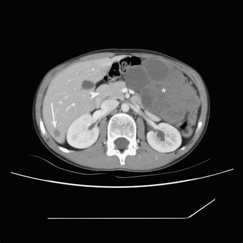 Tumor Desmopl Stico De C Lulas Peque As Y Redondas Abdominal Hallazgos