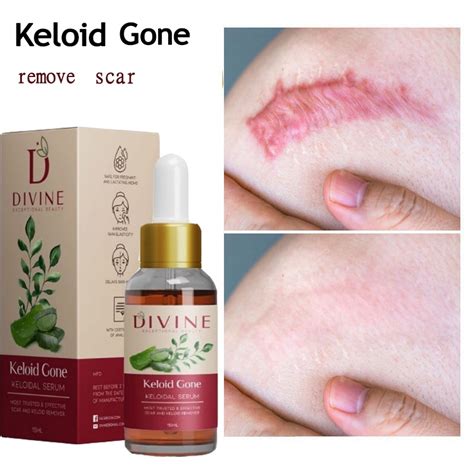 Keloid Gone And Scar Eliminate Keloids Scar Remover For Old Scar