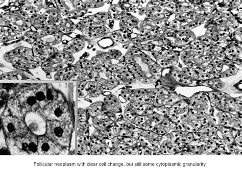 Pathology Outlines Clear Cell Change