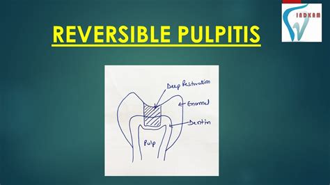 Reversible Pulpitis Hyperemiahyperactive Pulpalgia November 15 2022