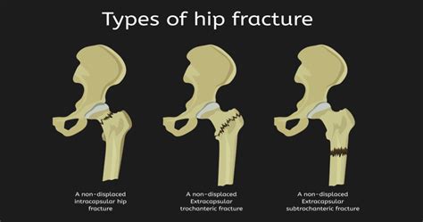 Don't Delay Hip Fracture Surgery. Here's Why - Comprehensive Orthopaedics
