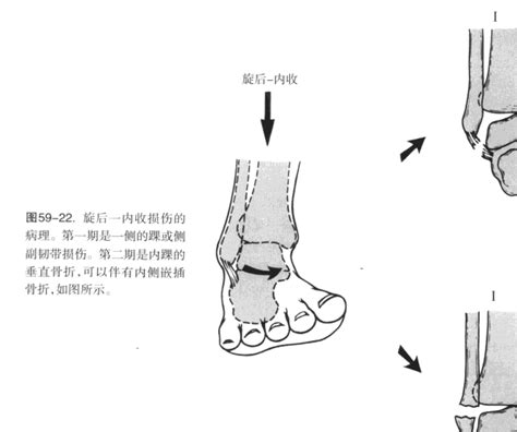 踝关节骨折的Lange Hansen分型图谱 word文档在线阅读与下载 免费文档