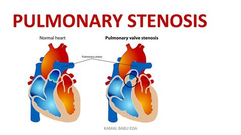 Pulmonary Stenosis Youtube