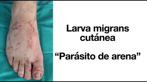 Larva Migrans Cut Nea Par Sito De Arena Ancylostoma Youtube