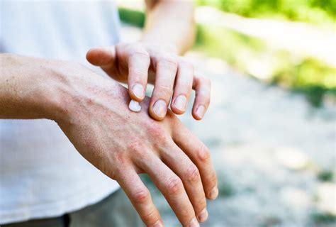 Eczema: Causes, Home Remedies, Diet and Tips - eMediHealth