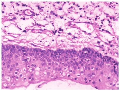 Photomicrograph Revealing That The Wall Of The Keratocystic Odontogenic