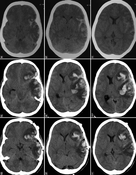 A C Initial Computed Tomography Scan Showing Subarachnoid Hemorrhage Download Scientific