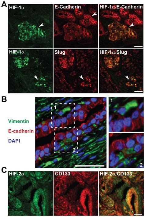 Co Expression Of Hypoxia Emt And Csc Markers In Pancreatic Cancer