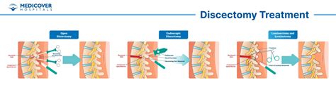 Discectomy Preparation Procedure And Recovery