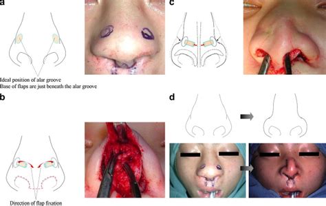 Alar Groove Plasty Using A Subcutaneous Flap Technique In Bulbous Nose