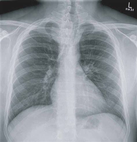 Chest X Ray Demonstrating Marked Tracheal Deviation To The Left Due To Download Scientific