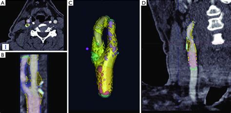 Visual 3 D MRI Cross Sectional Representations Of Severe Stenosis In