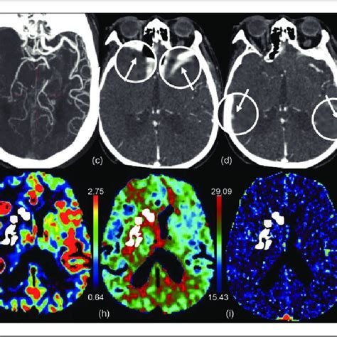 Baseline Ct Angiography And Perfusion Images And Follow Up Ct Images In Download Scientific