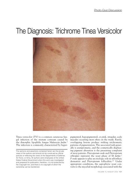 Pityriasis Versicolor Alba Tinea Versicolor Or Pityriasis Alba In