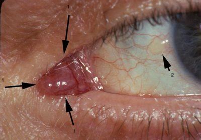 strange ball of skin in the corner of my eye (went to doc) - Page 2 - AR15.COM