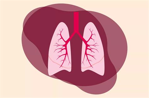 Jenis Jenis Pneumonia Yang Perlu Diketahui