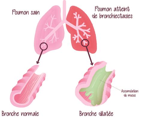 Dilatation Des Bronches Ddb Ou Bronchectasie Respifil Filière De