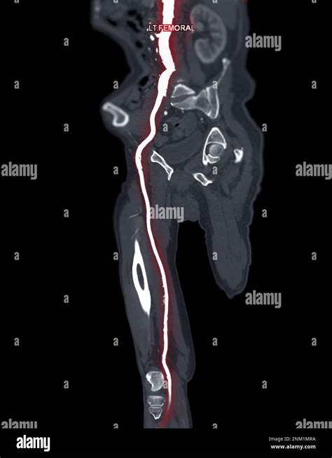 Cta Femoral Artery Run Off Mpr Curve Showing Left Femoral Artery For