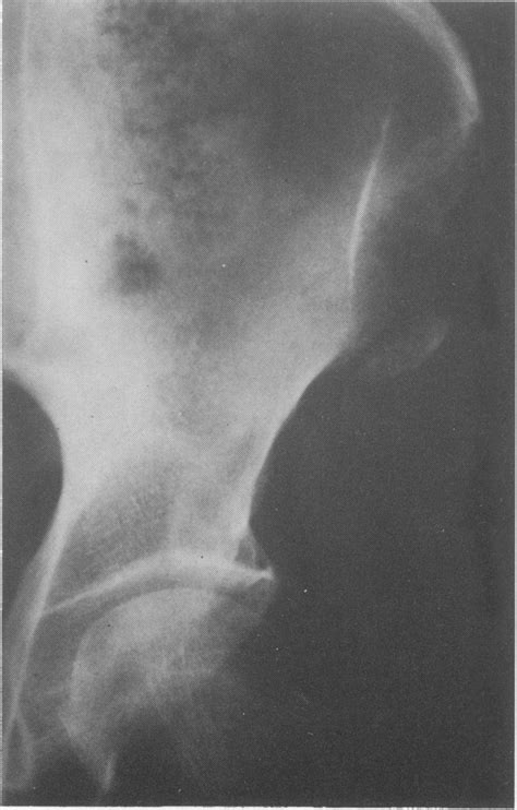 Radiograph Of Right Hip Showing An Avulsion Fracture Of The Anterior