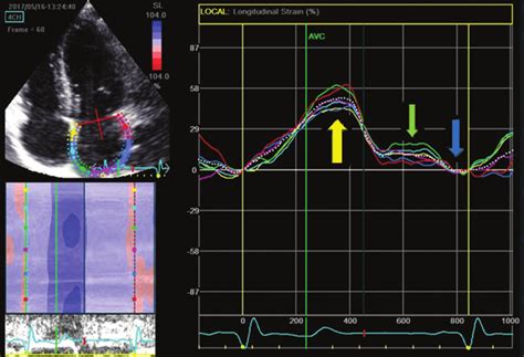 Example Of Left Atrium Two Dimensional Speckle Tracking Download