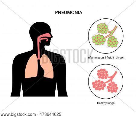 Disease pneumonia lungs prevent spread covid-19 Vector Image - Clip Art Library