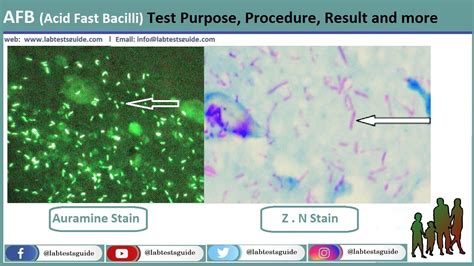 Csf For Afb Test Purpose Procedure Result And More Lab Tests Guide