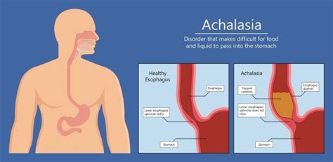 Akalasia Gejala Penyebab Dan Mengobati Alodokter