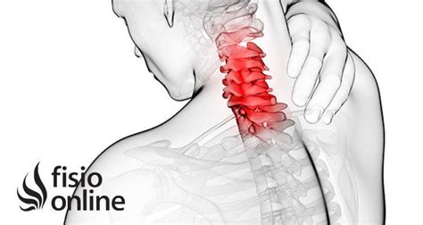 Artrosis cervical o cervicoartrosis Causas síntomas y tratamiento