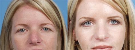 Eyelid Surgery Before And After Pictures Case 62 Chicago IL TLKM