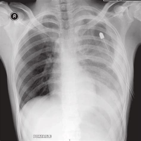 Chest Radiograph Postero Anterior View After Chest Tube Insertion