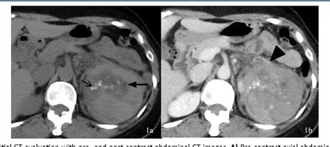 Figure 1 From Malignant Renal Epithelioid Angiomyolipoma With Liver