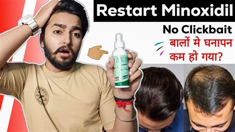 Restart Using Minoxidil No Clickbait Again Start Minoxidil Sahil