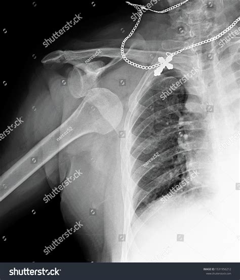 Radiograph Shoulder Joint Dislocation Head Humerus Foto Stok 1531956212 ...