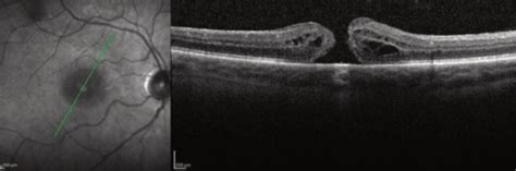 Macular Hole, Macular Hole Surgery, Macular Hole Causes