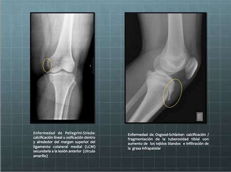 Seram S Valoraci N Radiol Gica De La Rodilla Anatom A