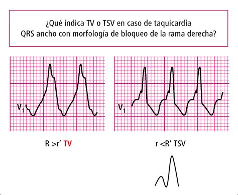 Caso clínico taquicardia de QRS ancho Parte 2 página 2 Guías y