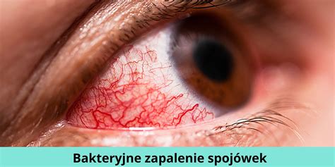 Bakteryjne zapalenie spojówek objawy leczenie